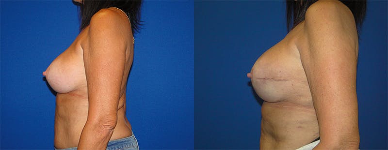 Breast Reconstruction Before & After Gallery - Patient 74861924 - Image 2