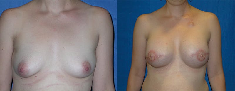 Breast Reconstruction Gallery - Patient 74861926 - Image 1