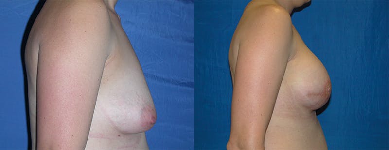 Breast Reconstruction Before & After Gallery - Patient 74861926 - Image 2