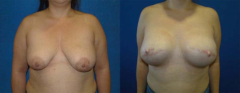 Breast Reconstruction Before & After Gallery - Patient 74861927 - Image 1
