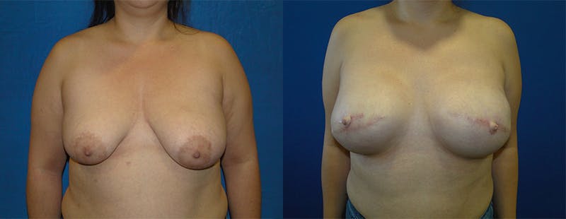 Breast Reconstruction Before & After Gallery - Patient 74861927 - Image 1