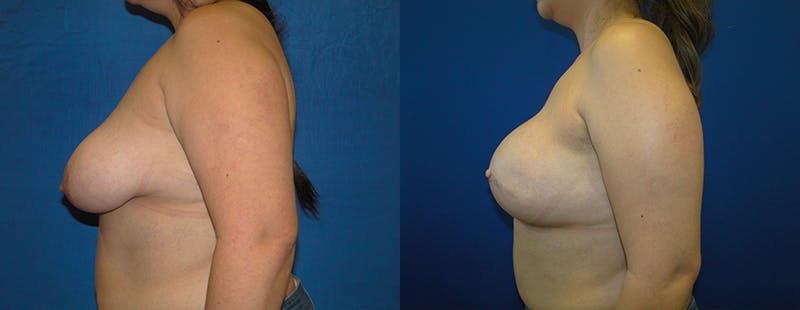Breast Reconstruction Before & After Gallery - Patient 74861927 - Image 2