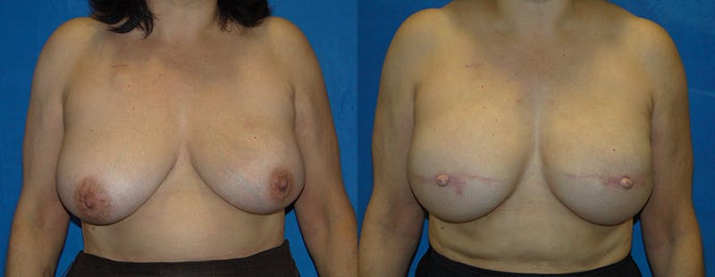 Breast Reconstruction Before & After Gallery - Patient 74861928 - Image 1