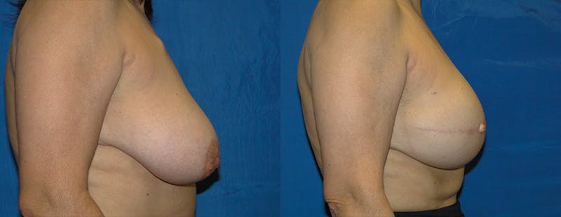 Breast Reconstruction Before & After Gallery - Patient 74861928 - Image 2