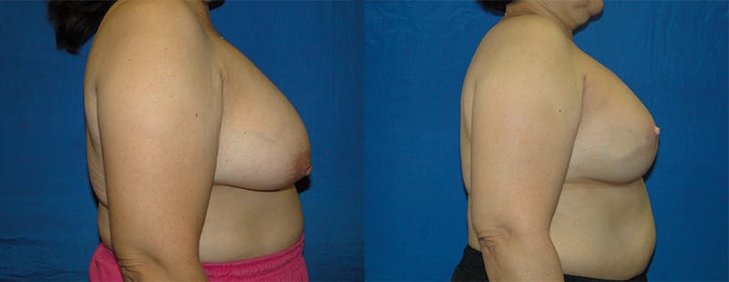 Breast Reconstruction Before & After Gallery - Patient 74861929 - Image 2