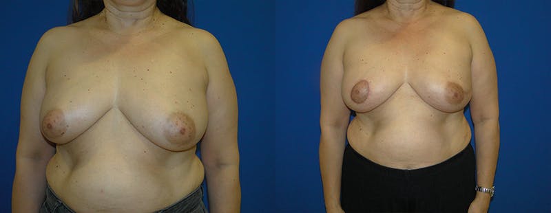 Breast Reconstruction Before & After Gallery - Patient 74861930 - Image 1