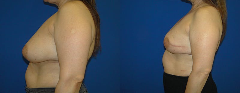 Breast Reconstruction Before & After Gallery - Patient 74861930 - Image 2