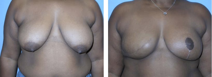 Breast Reconstruction Before & After Gallery - Patient 74861931 - Image 1