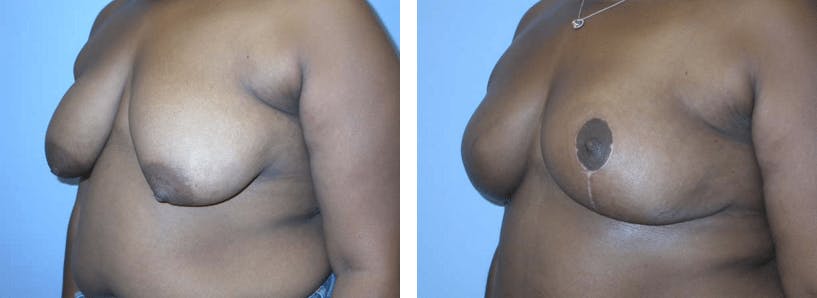 Breast Reconstruction Before & After Gallery - Patient 74861931 - Image 2