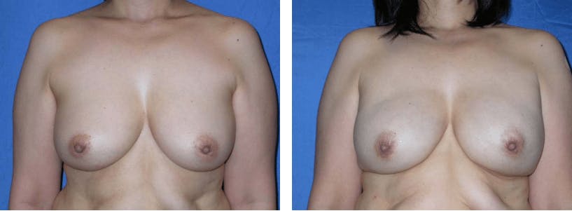 Breast Reconstruction Gallery - Patient 74866164 - Image 1