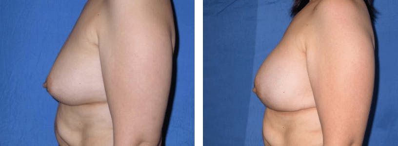 Breast Reconstruction Gallery - Patient 74866164 - Image 2