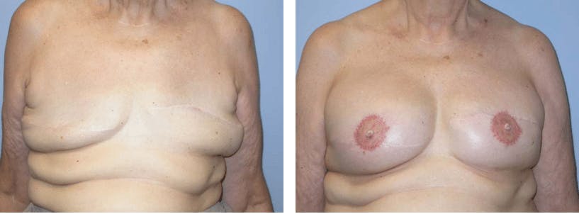Breast Reconstruction Before & After Gallery - Patient 74866165 - Image 1