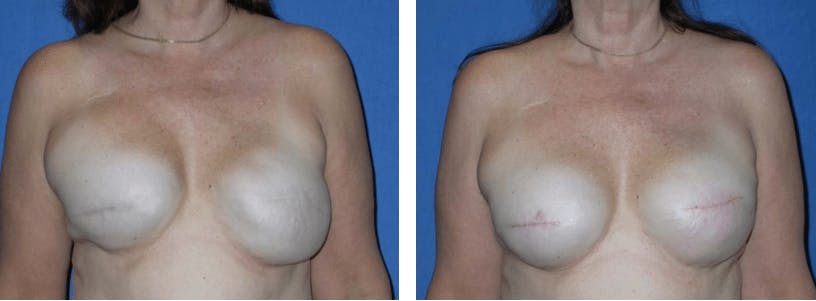 Breast Reconstruction Before & After Gallery - Patient 74866166 - Image 1