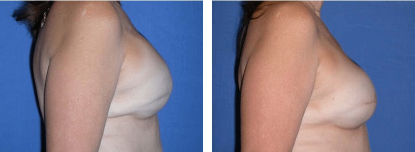 Breast Reconstruction Before & After Gallery - Patient 74866166 - Image 2