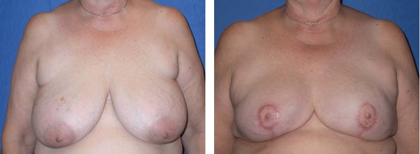 Breast Reconstruction Gallery - Patient 74866167 - Image 1