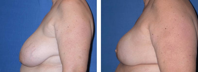 Breast Reconstruction Before & After Gallery - Patient 74866167 - Image 2