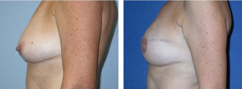 Breast Reconstruction Before & After Gallery - Patient 74866168 - Image 2