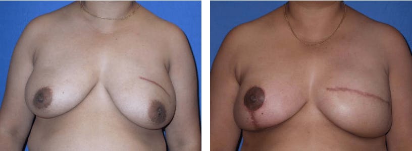 Breast Reconstruction Gallery - Patient 74866169 - Image 1
