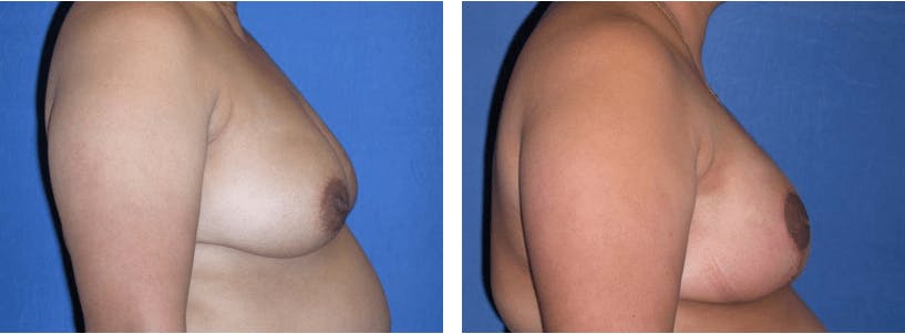 Breast Reconstruction Before & After Gallery - Patient 74866169 - Image 2