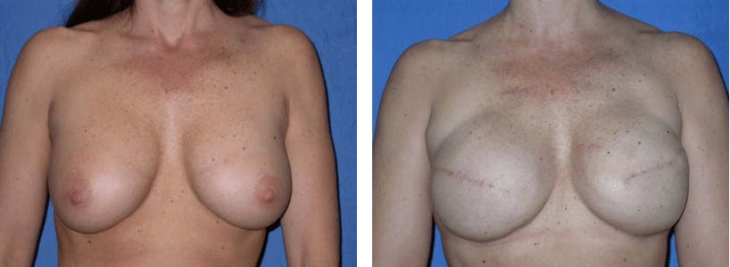 Breast Reconstruction Before & After Gallery - Patient 74866171 - Image 1