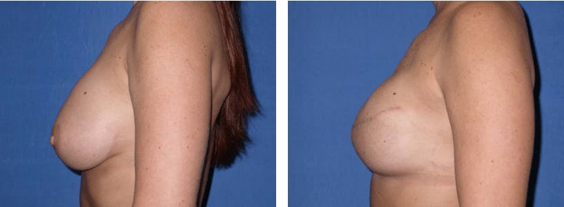 Breast Reconstruction Before & After Gallery - Patient 74866171 - Image 2