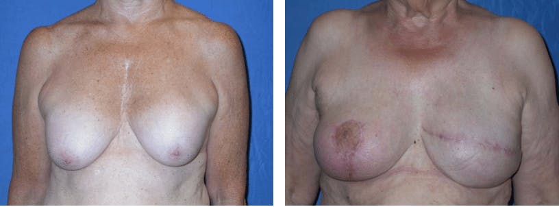 Breast Reconstruction Before & After Gallery - Patient 74866173 - Image 1