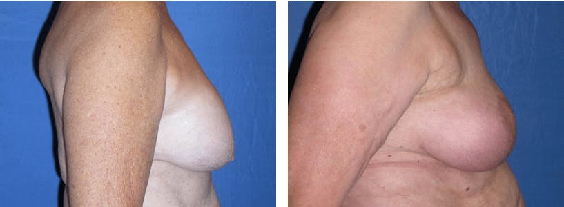 Breast Reconstruction Before & After Gallery - Patient 74866173 - Image 2