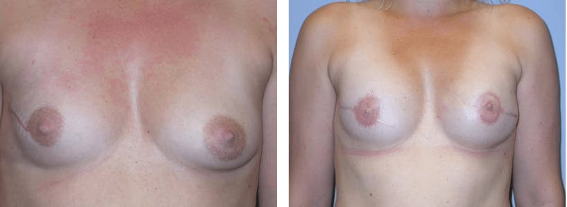 Breast Reconstruction Before & After Gallery - Patient 74866174 - Image 1