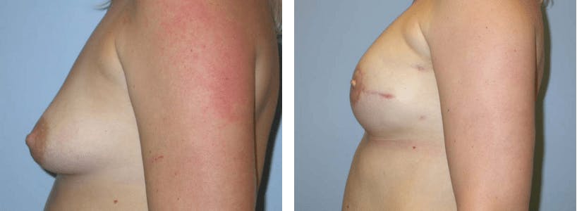 Breast Reconstruction Before & After Gallery - Patient 74866174 - Image 2