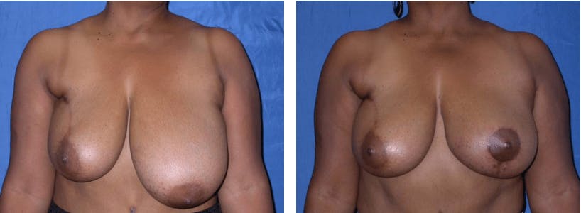 Breast Reconstruction Gallery - Patient 74866175 - Image 1