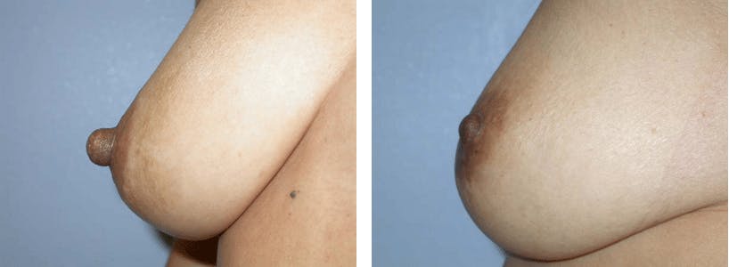 Nipple Reduction Before & After Gallery - Patient 74866182 - Image 1