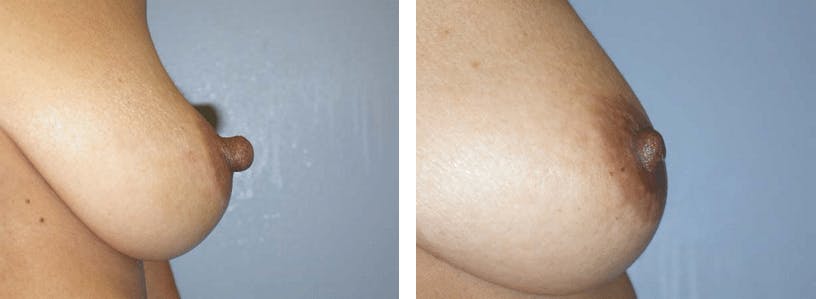 Nipple Reduction Before & After Gallery - Patient 74866182 - Image 2