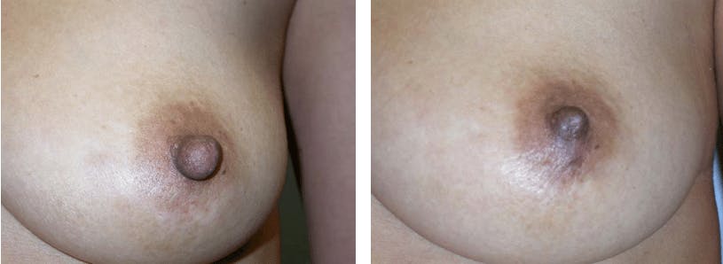 Nipple Reduction Before & After Gallery - Patient 74866182 - Image 3