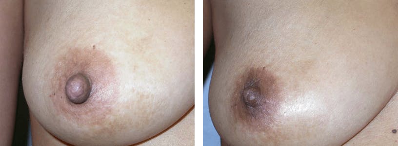 Nipple Reduction Before & After Gallery - Patient 74866182 - Image 4