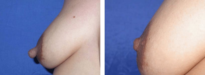 Nipple Reduction Before & After Gallery - Patient 74866184 - Image 1