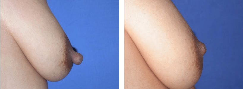 Nipple Reduction Before & After Gallery - Patient 74866184 - Image 2