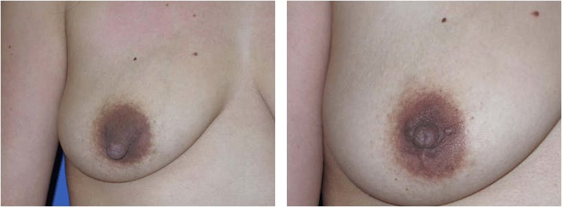 Nipple Reduction Before & After Gallery - Patient 74866184 - Image 3