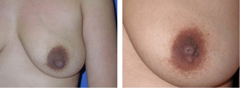 Nipple Reduction Before & After Gallery - Patient 74866184 - Image 4
