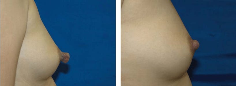 Nipple Reduction Before & After Gallery - Patient 74866185 - Image 1