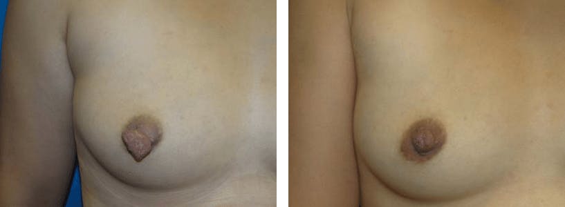Nipple Reduction Before & After Gallery - Patient 74866185 - Image 2