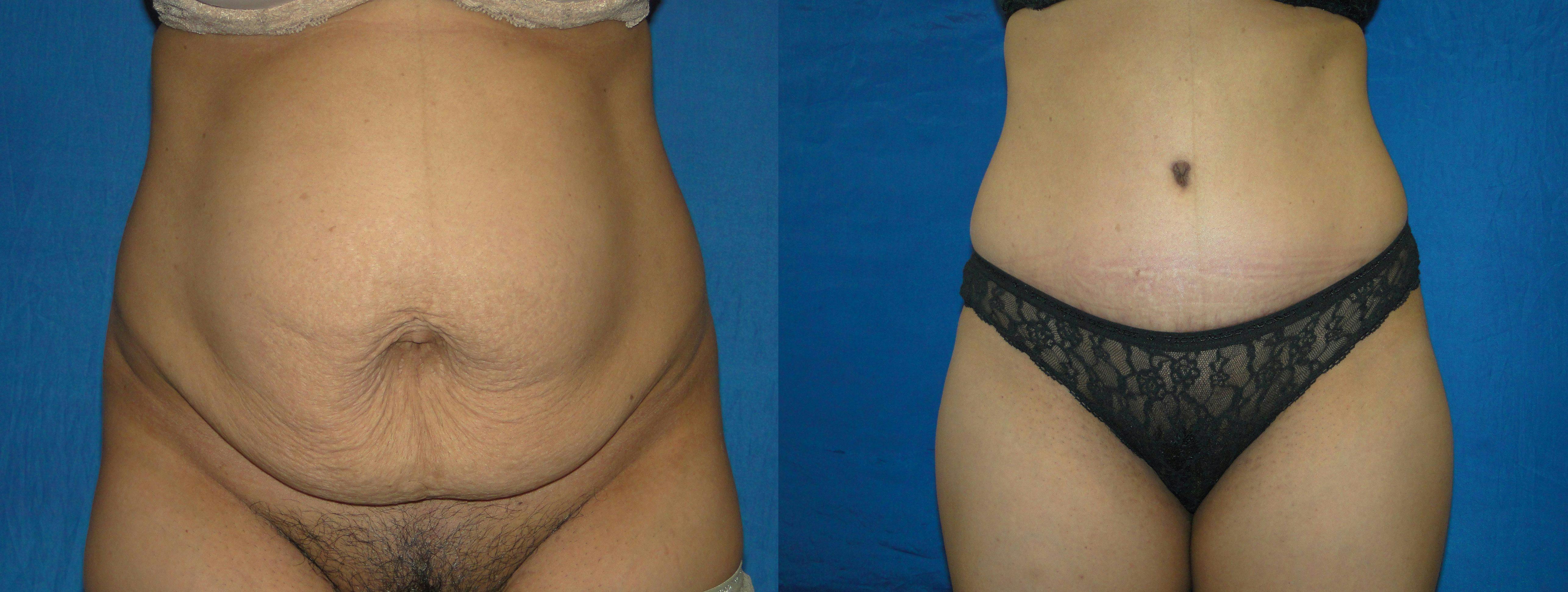 Tummy Tuck