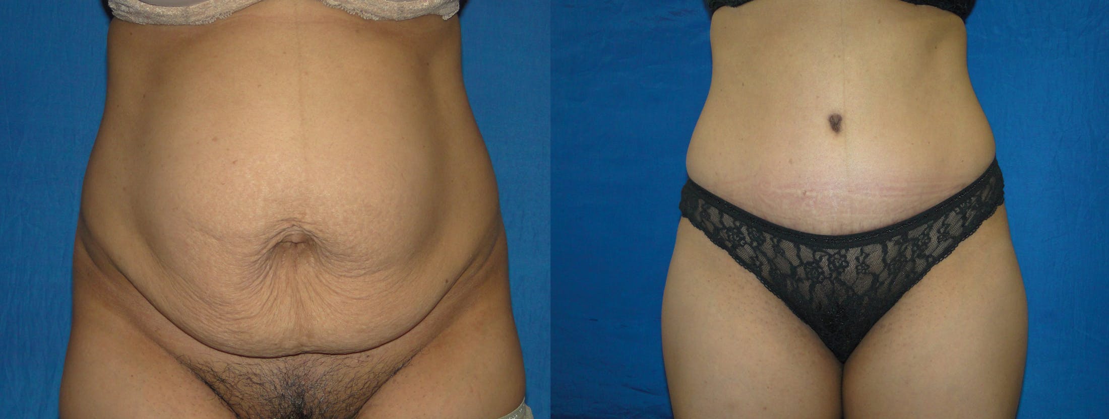 Tummy Tuck Before & After Gallery - Patient 74866186 - Image 1