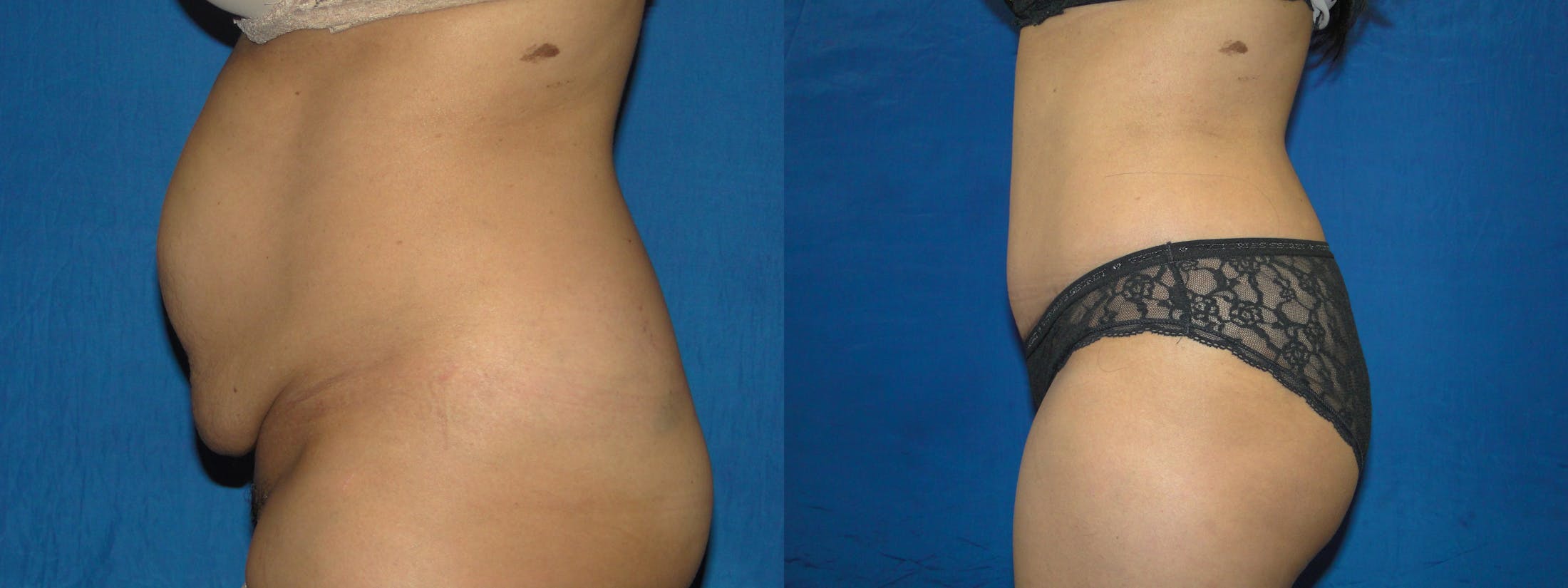Tummy Tuck Before & After Gallery - Patient 74866186 - Image 2