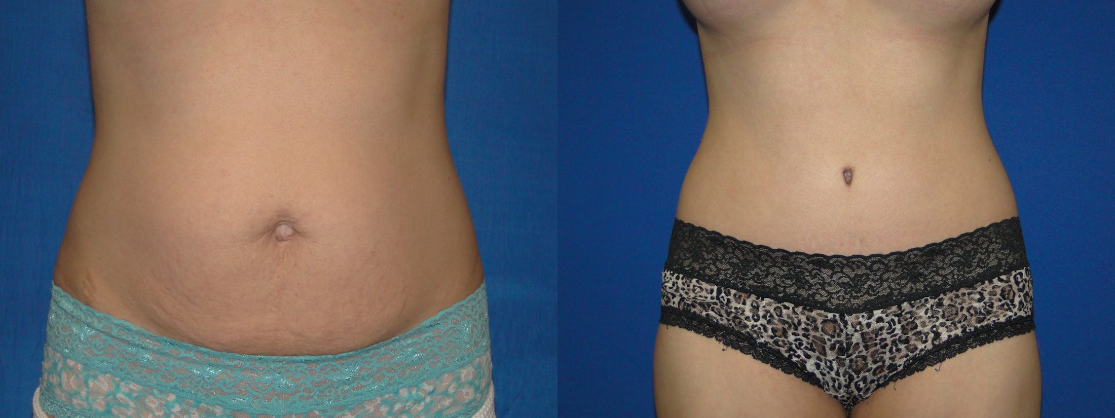 Tummy Tuck Before & After Gallery - Patient 74866189 - Image 1