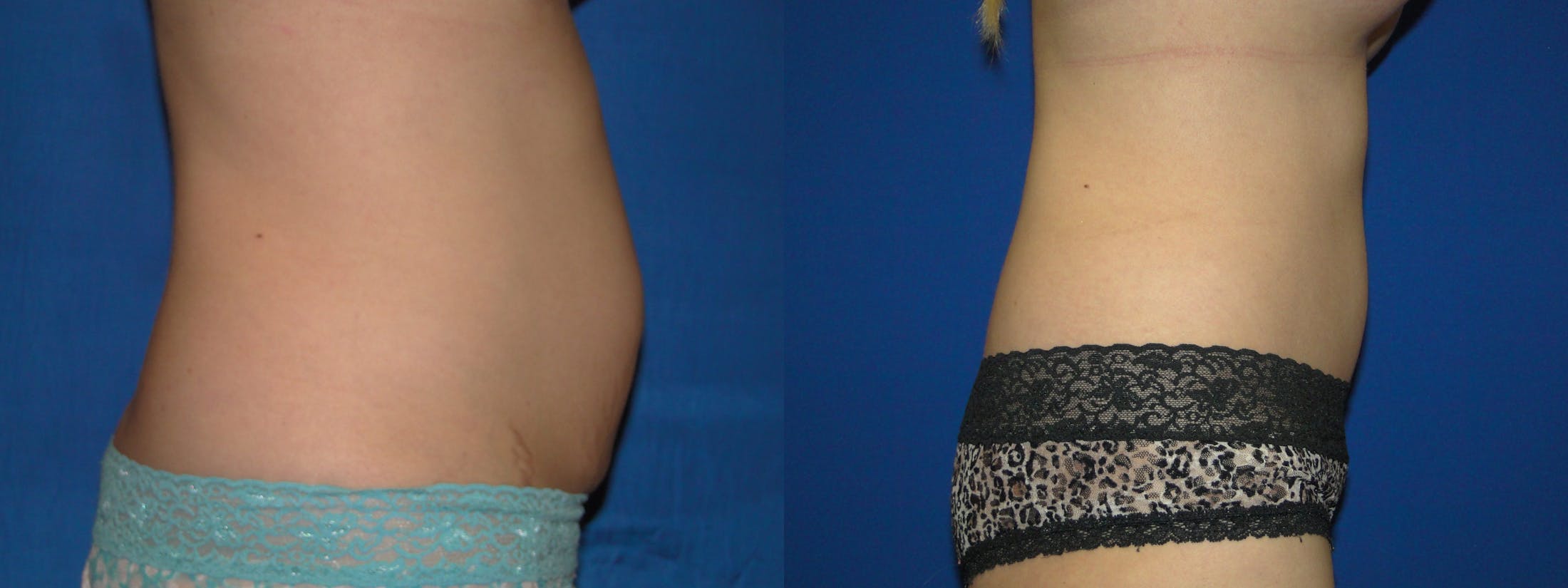 Tummy Tuck Before & After Gallery - Patient 74866189 - Image 2