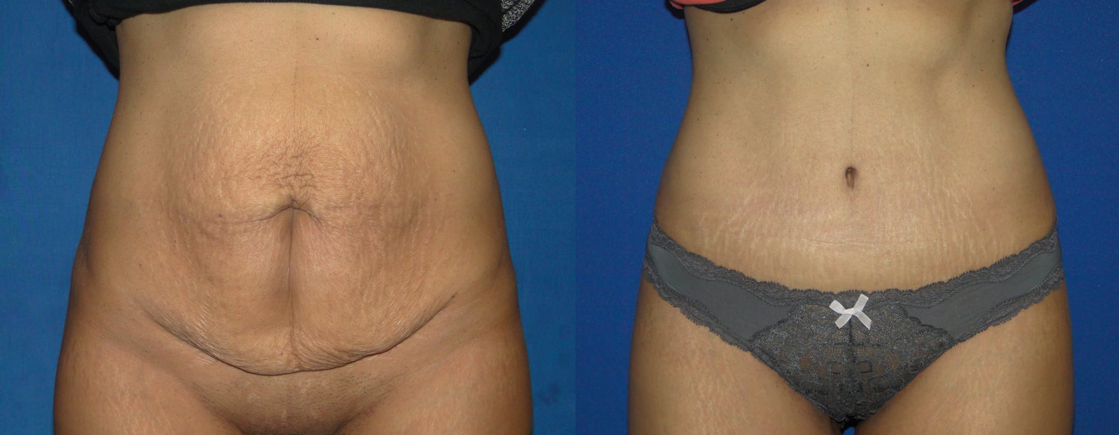 Tummy Tuck Before & After Gallery - Patient 74866190 - Image 1