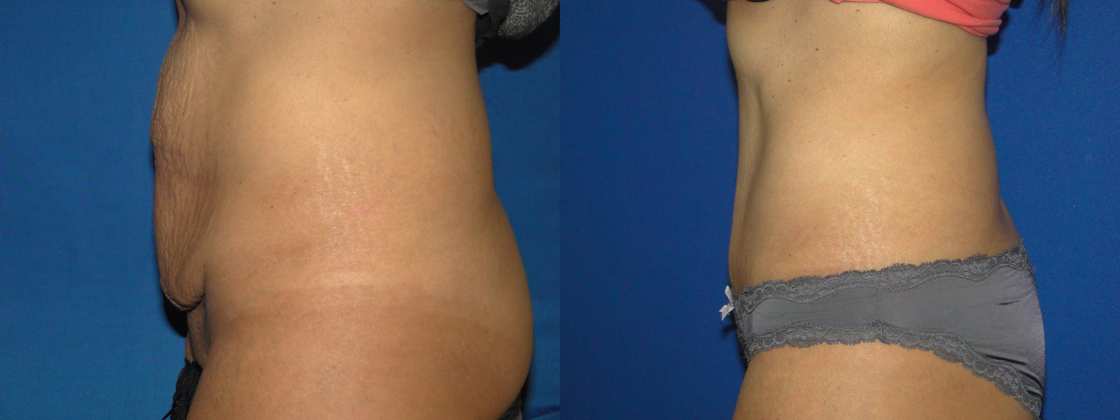 Tummy Tuck Gallery - Patient 74866190 - Image 2