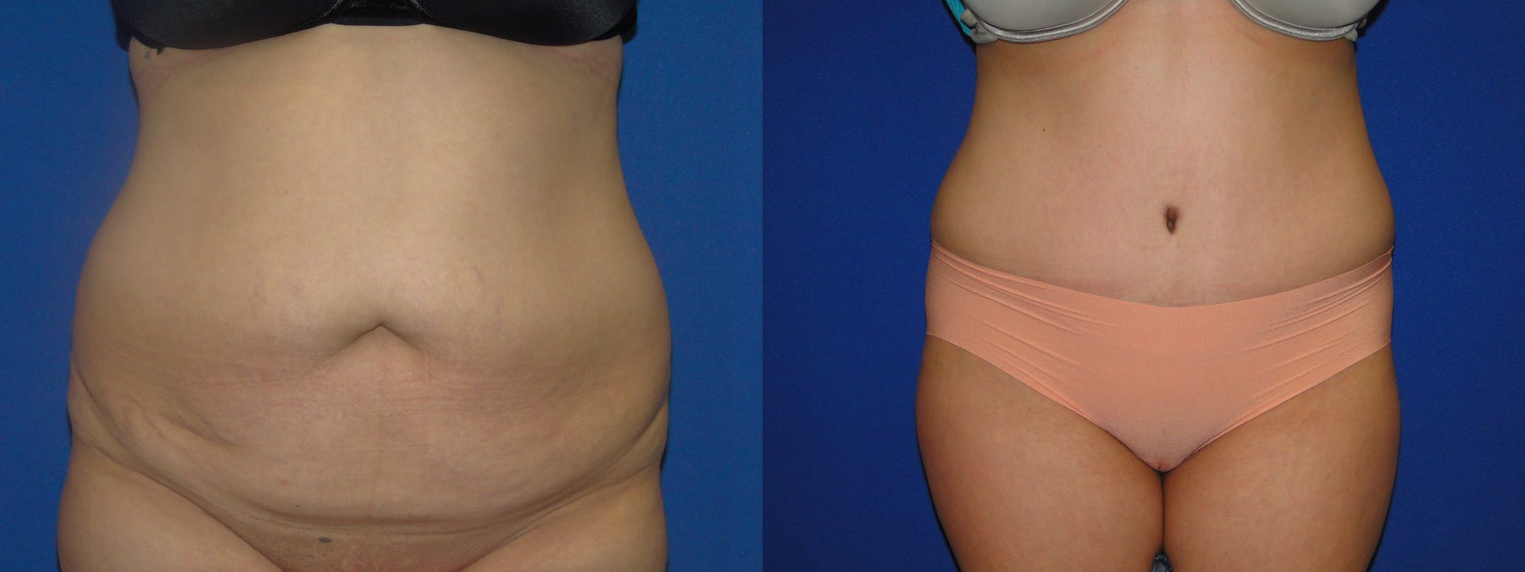 Tummy Tuck Before & After Gallery - Patient 74866192 - Image 1