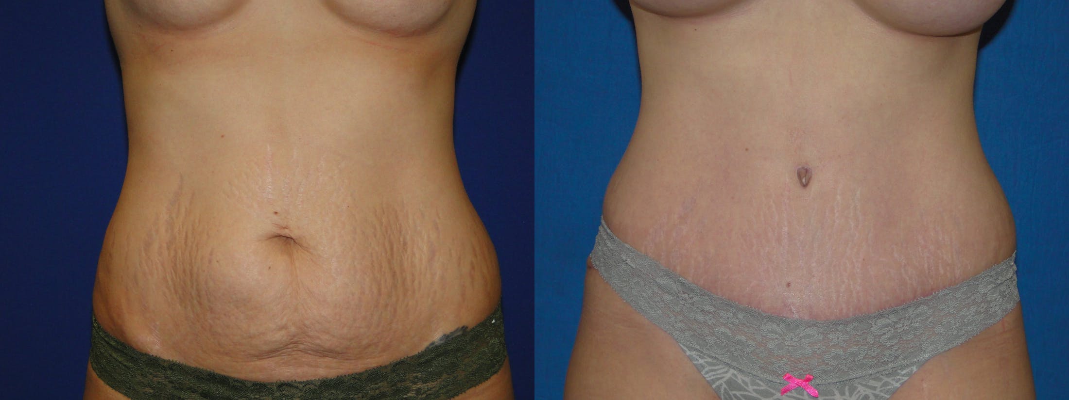 Tummy Tuck Before & After Gallery - Patient 74866194 - Image 1