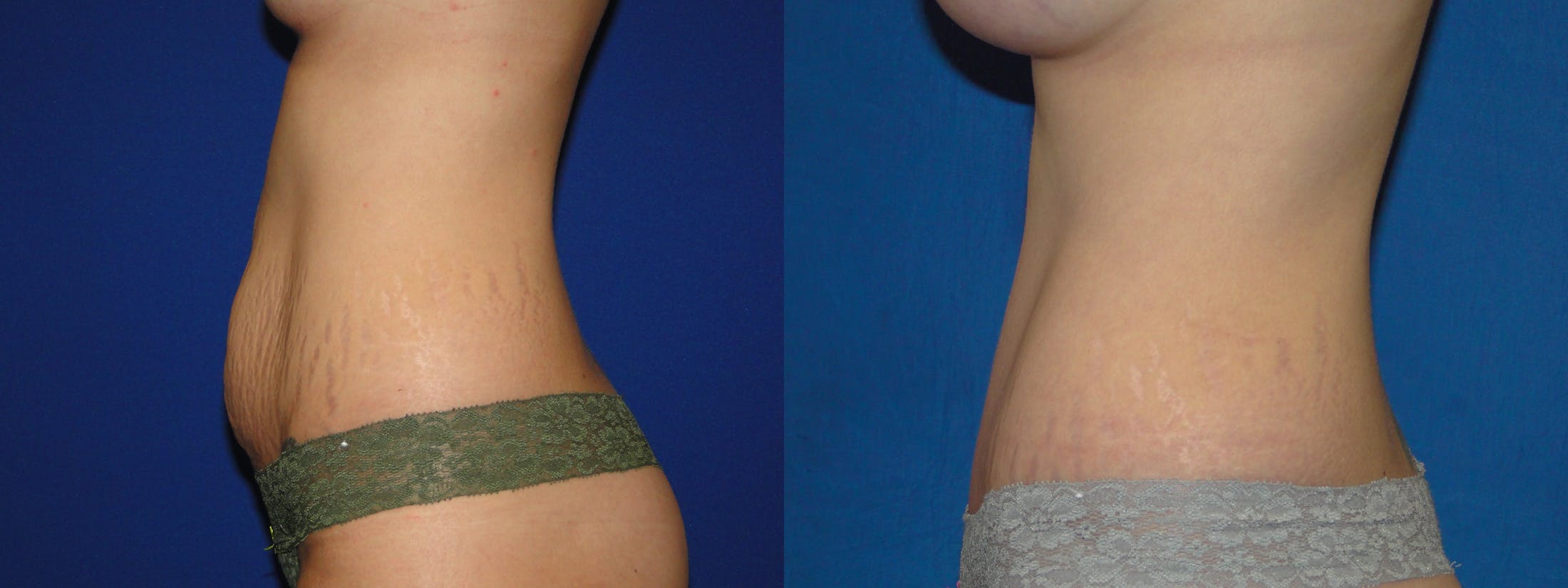 Tummy Tuck Before & After Gallery - Patient 74866194 - Image 2
